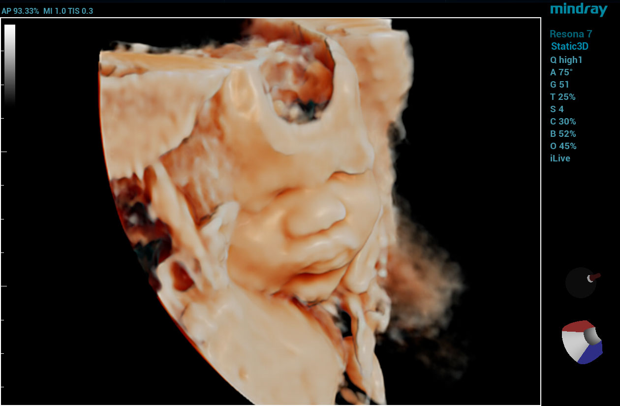 Resona 7 Image: 3D of baby face using D8-4U