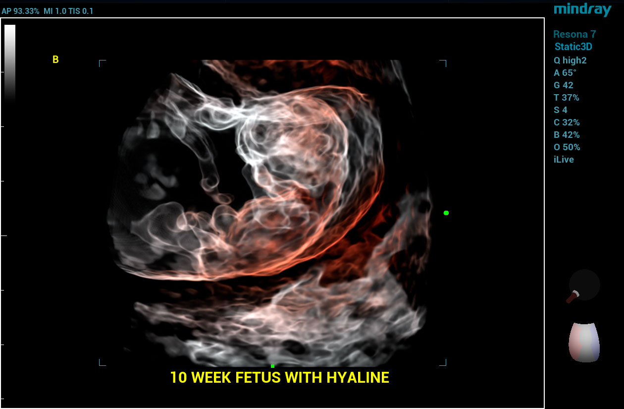 Resona 7 Image: Hyaline of 10 week fetus using DE10-3WU