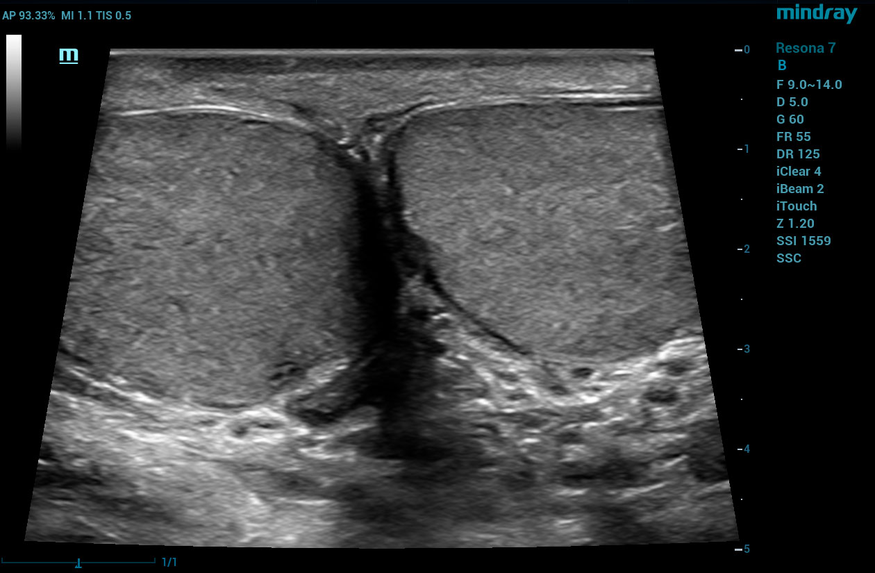 Resona 7 Image: B-mode of testicles using L14-5W