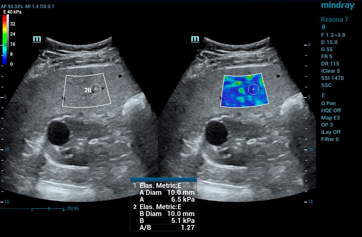 Resona 7 Image: STE of liver stiffness using SC5-1U