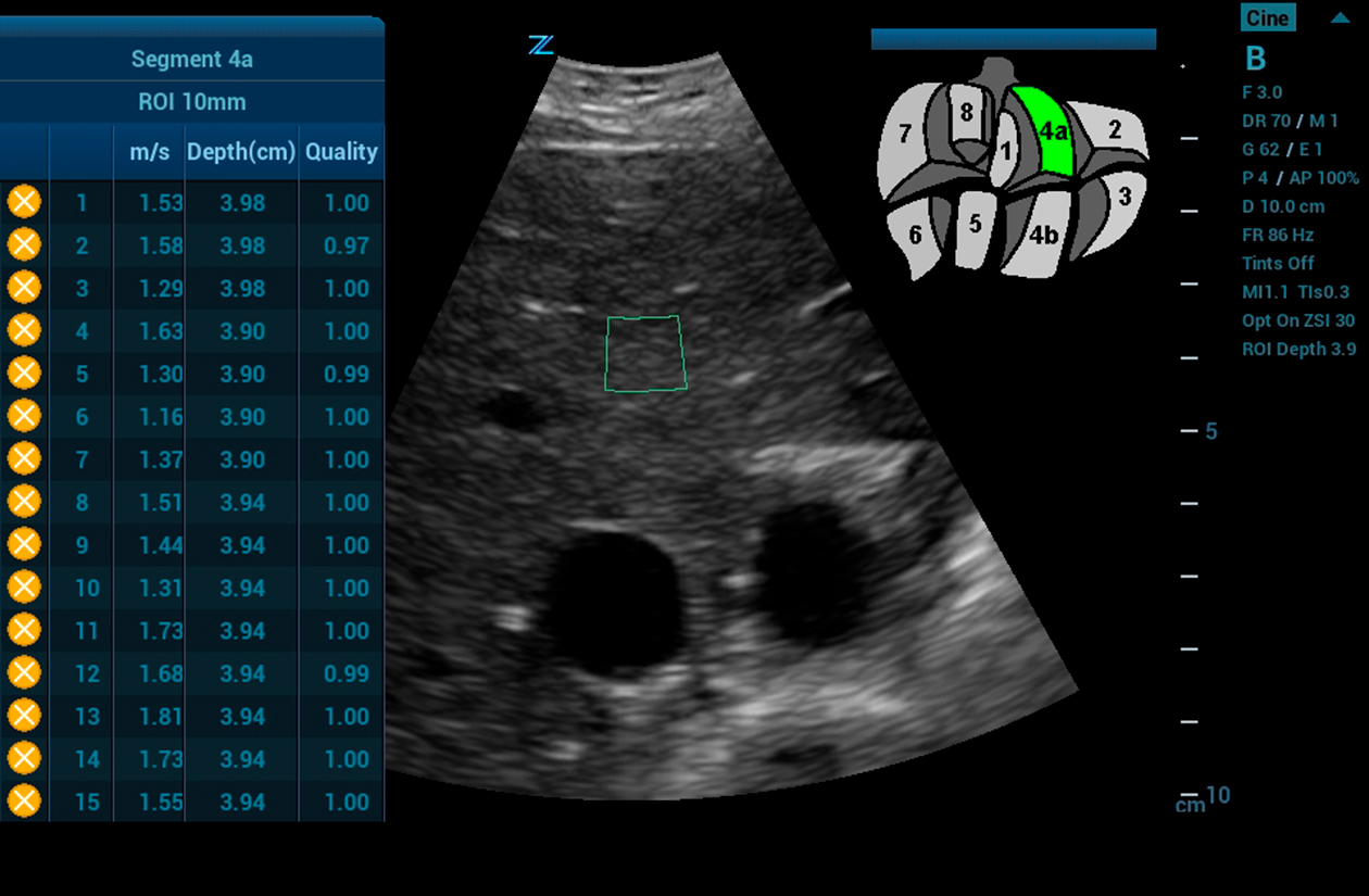 ZS3 Image: ARFI of right liver lobe using C4-1