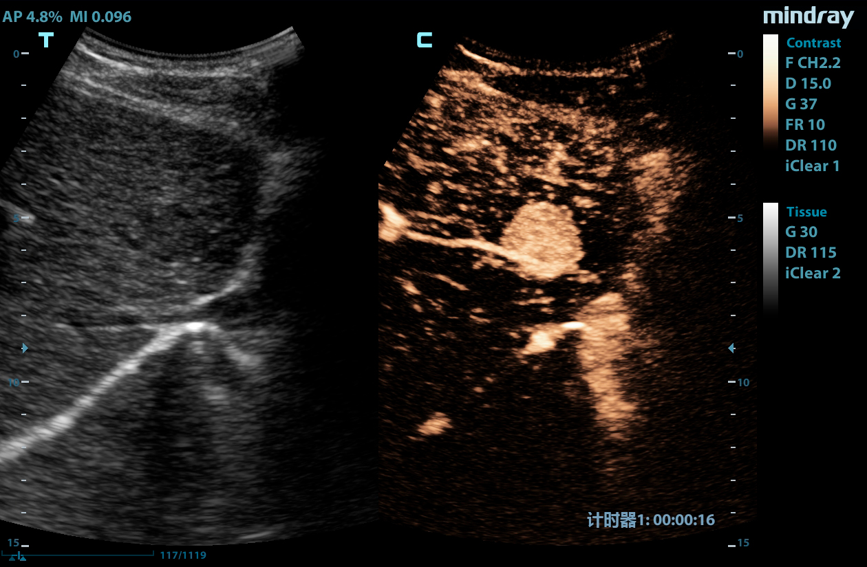 M9 Image: CEUS of liver cancer using C5-1s