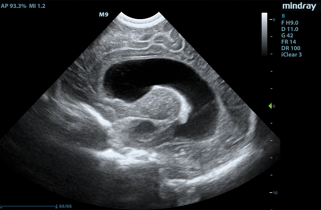 M9 Image: B-mode of baby head using C11-3s