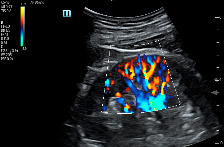 TE7 Image: Color Doppler of renal using C5-1s
