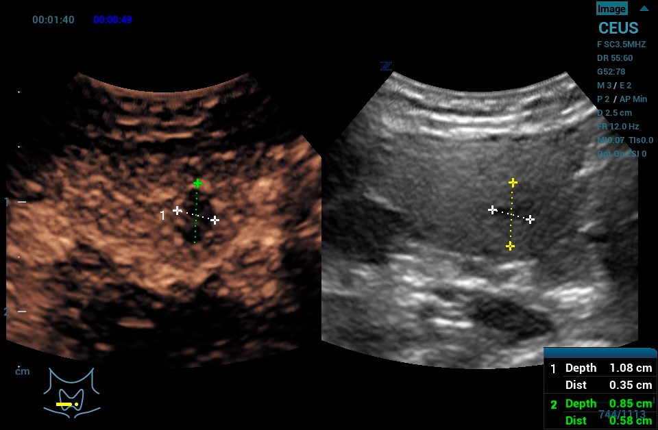 Z.One PRO image: CEUS of thyroid using C10-3