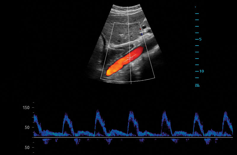 Z.One PRO image: Pulse Wave Doppler of Aorta using C6-2