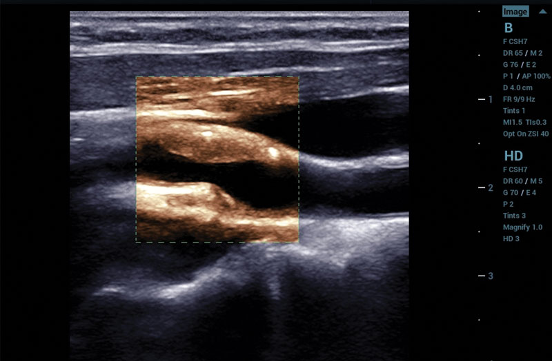 ZS3 Image: Carotid plaque with HD Scope