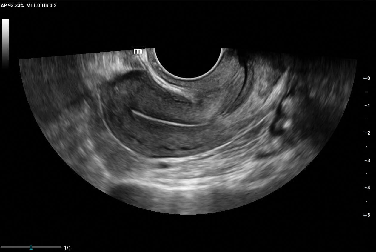 ultrasound scan of uterus