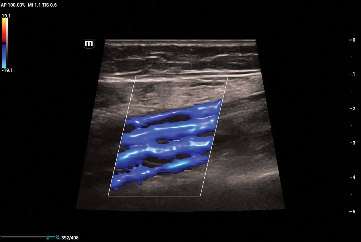 vascular ultrasound scan