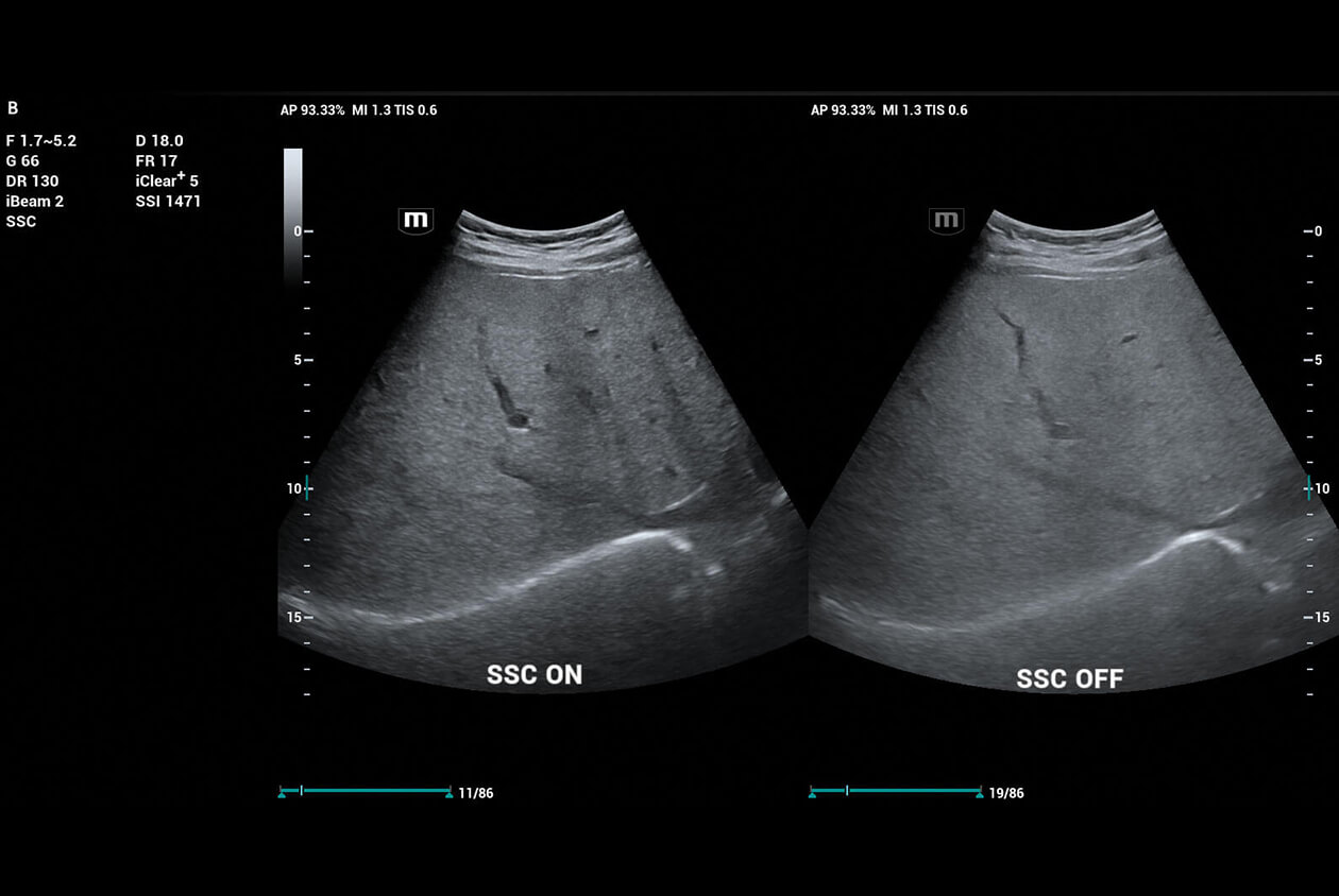 ultrasound of liver