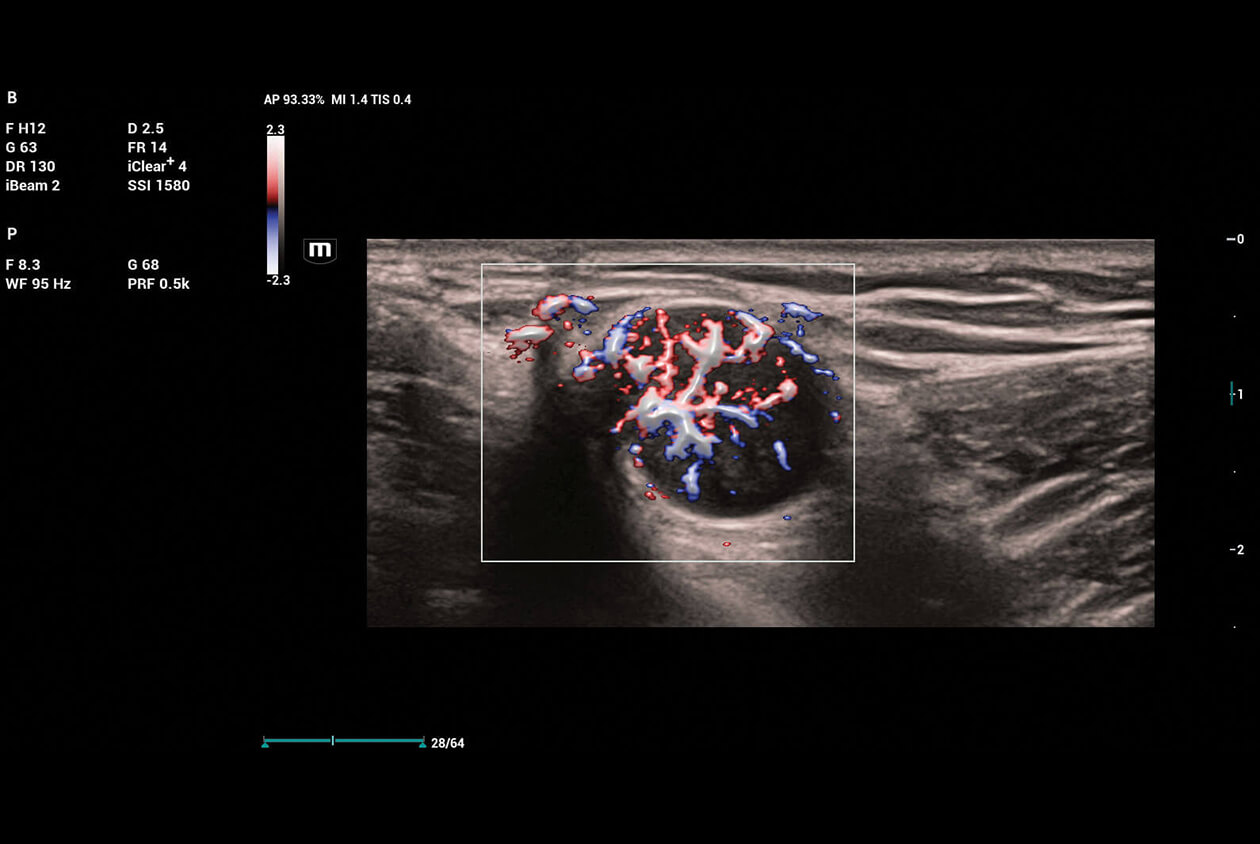 lymph node ultrasound