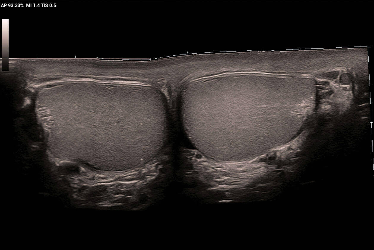 ultrasound of testicles