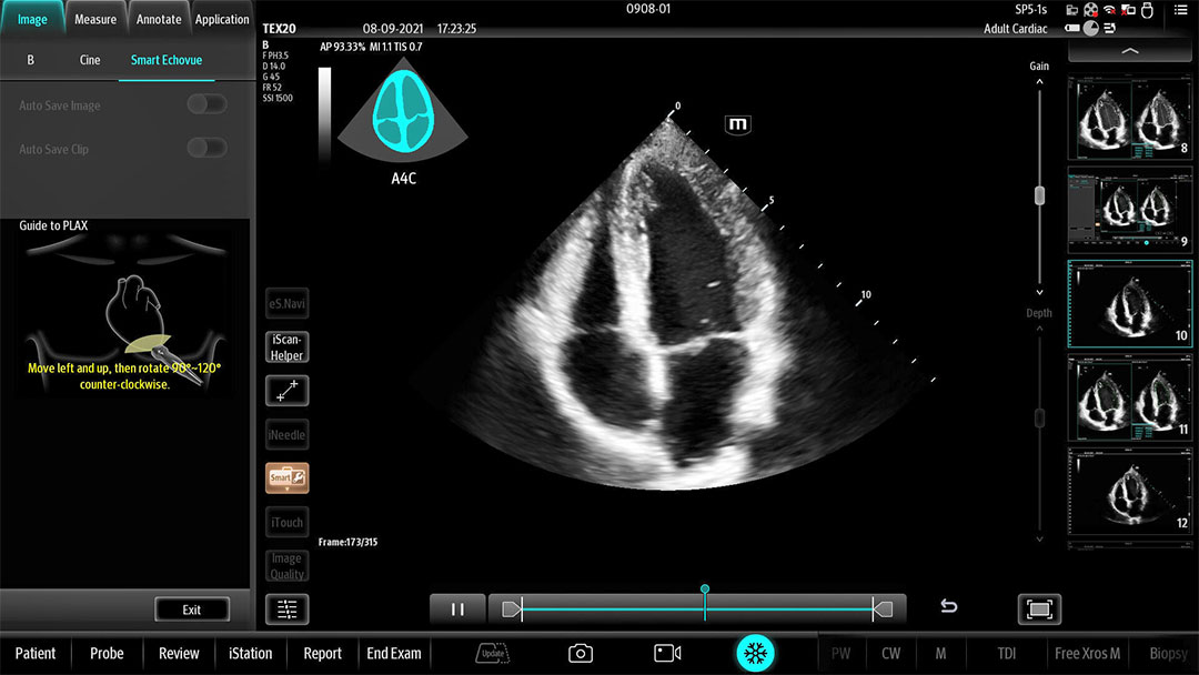 tex ultrasound mindray