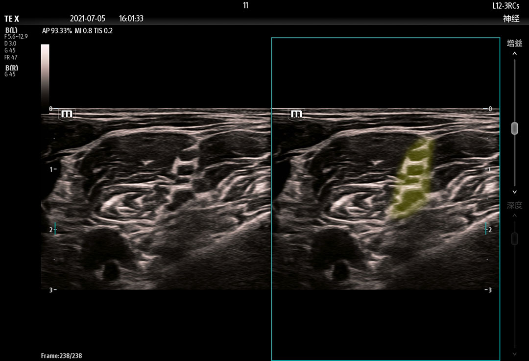 smart nerve ultrasound technology