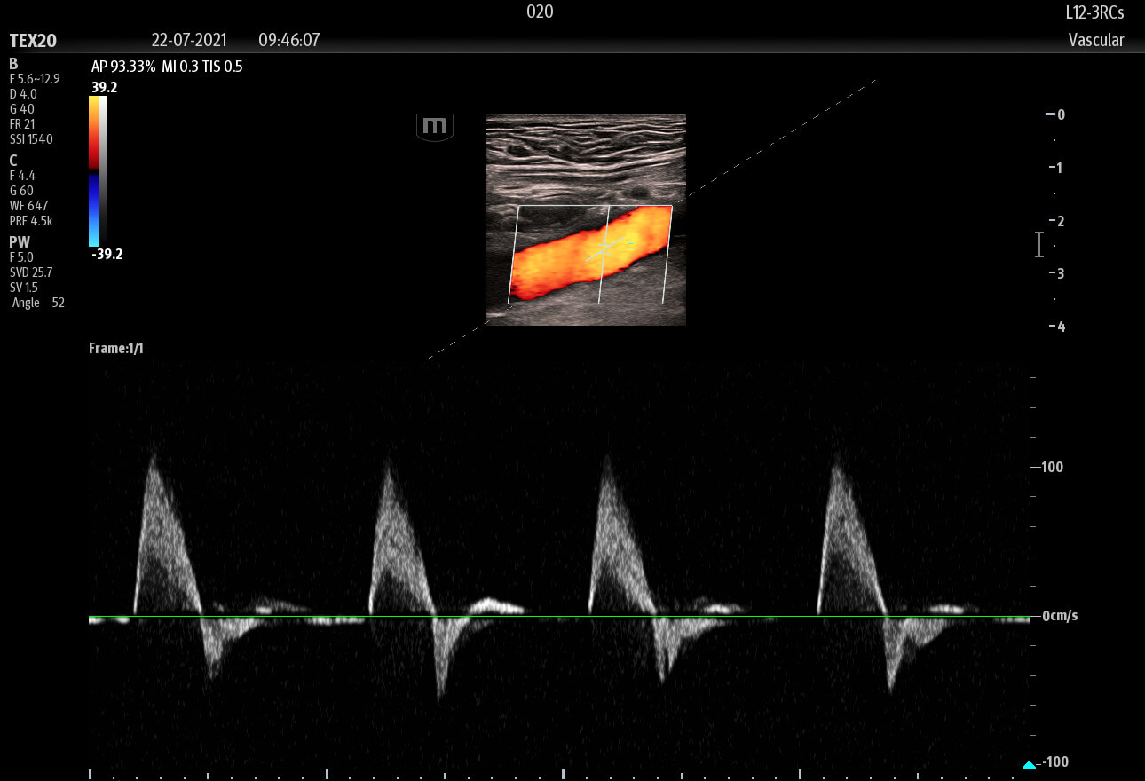 ultrasound aorta