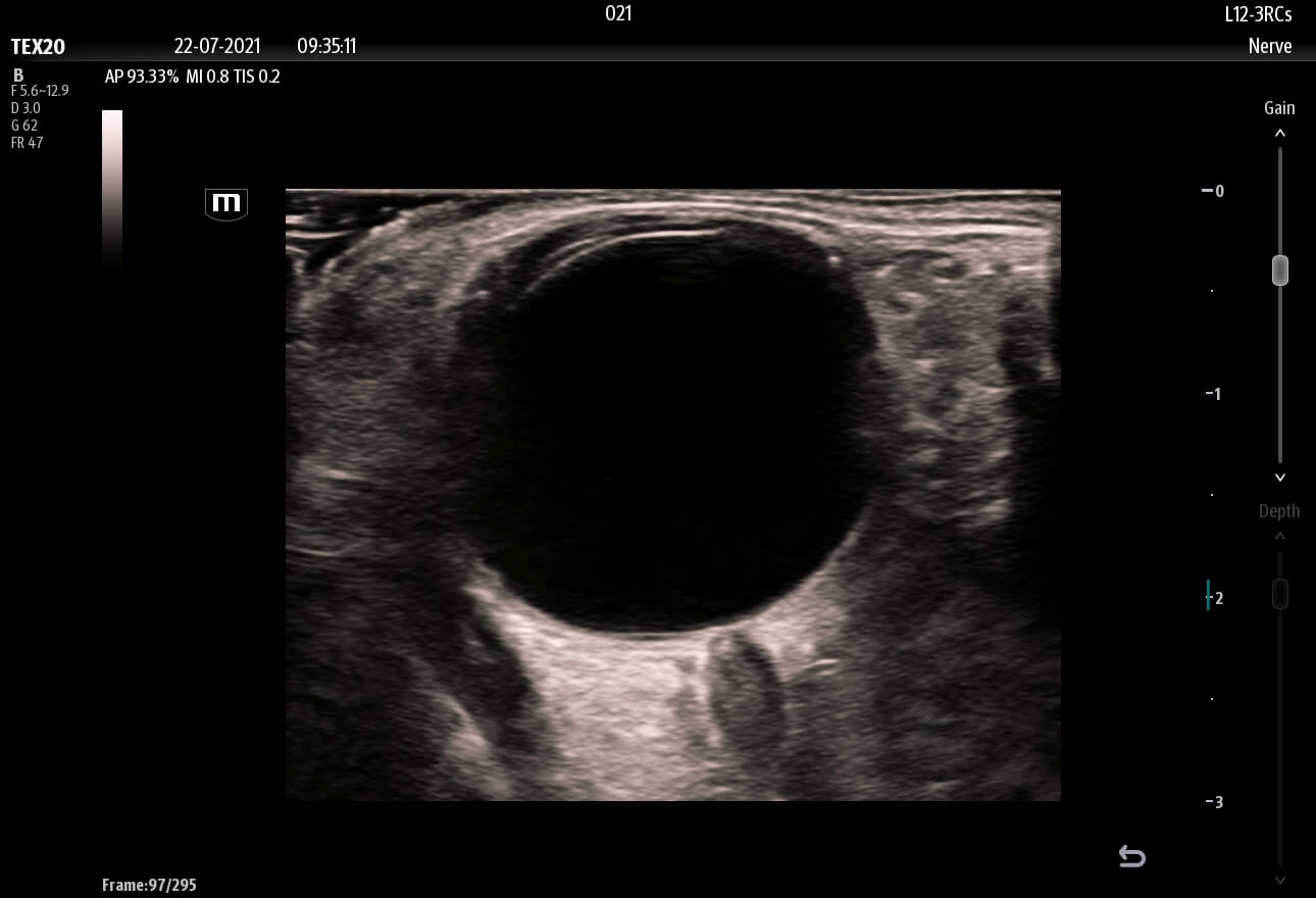 ultrasound nerve image