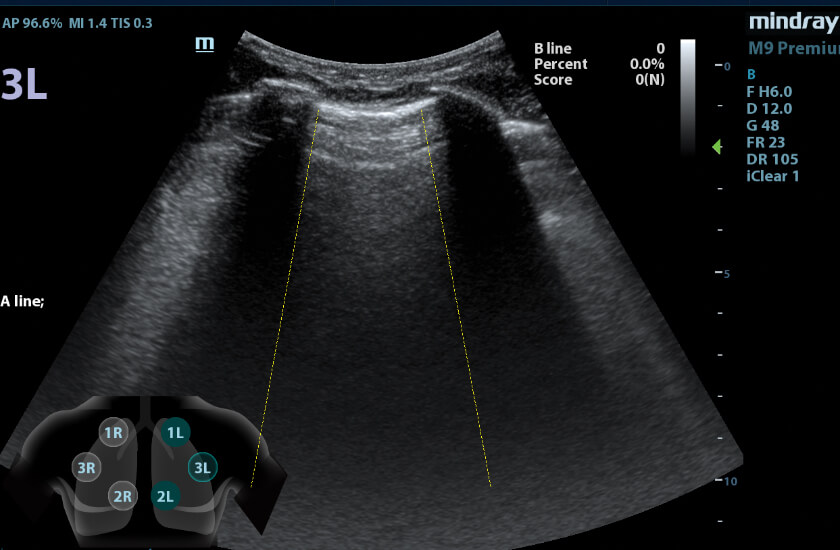 ultrasound scan mindray