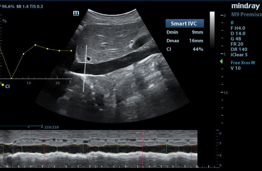 smart ultrasound mindray