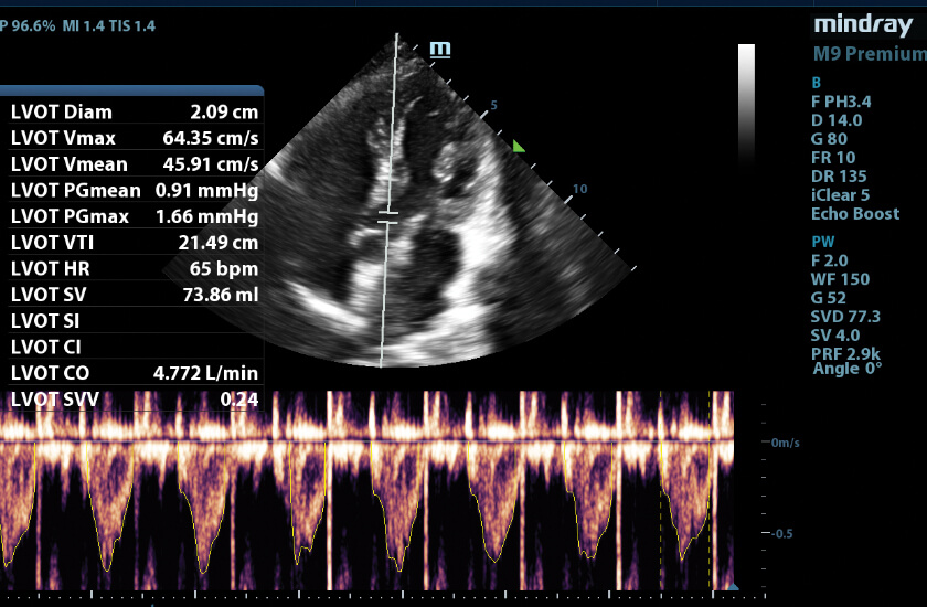 smart ultrasound image mindray