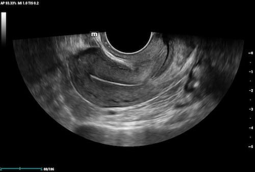 endocavity ultrasound of uterus