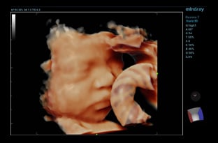 fetus ultrasound