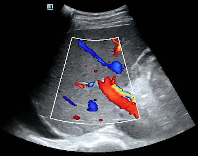 2d liver ultrasound