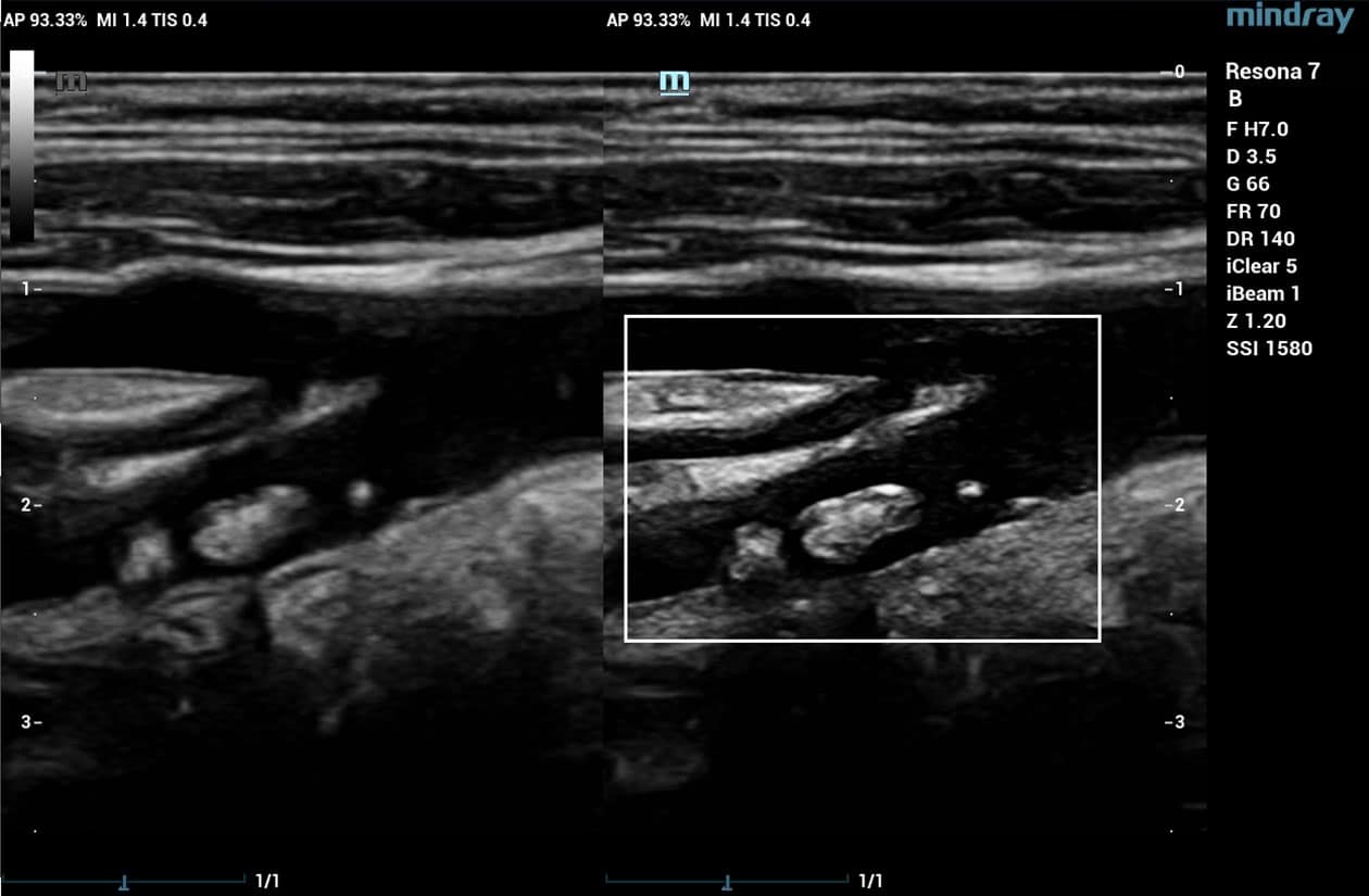 HD Scope of Carotid Artery Plaque